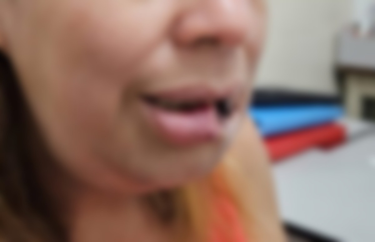 Mulher que teve parte dos lábios arrancados por companheiro passa por cirurgia de reconstrução