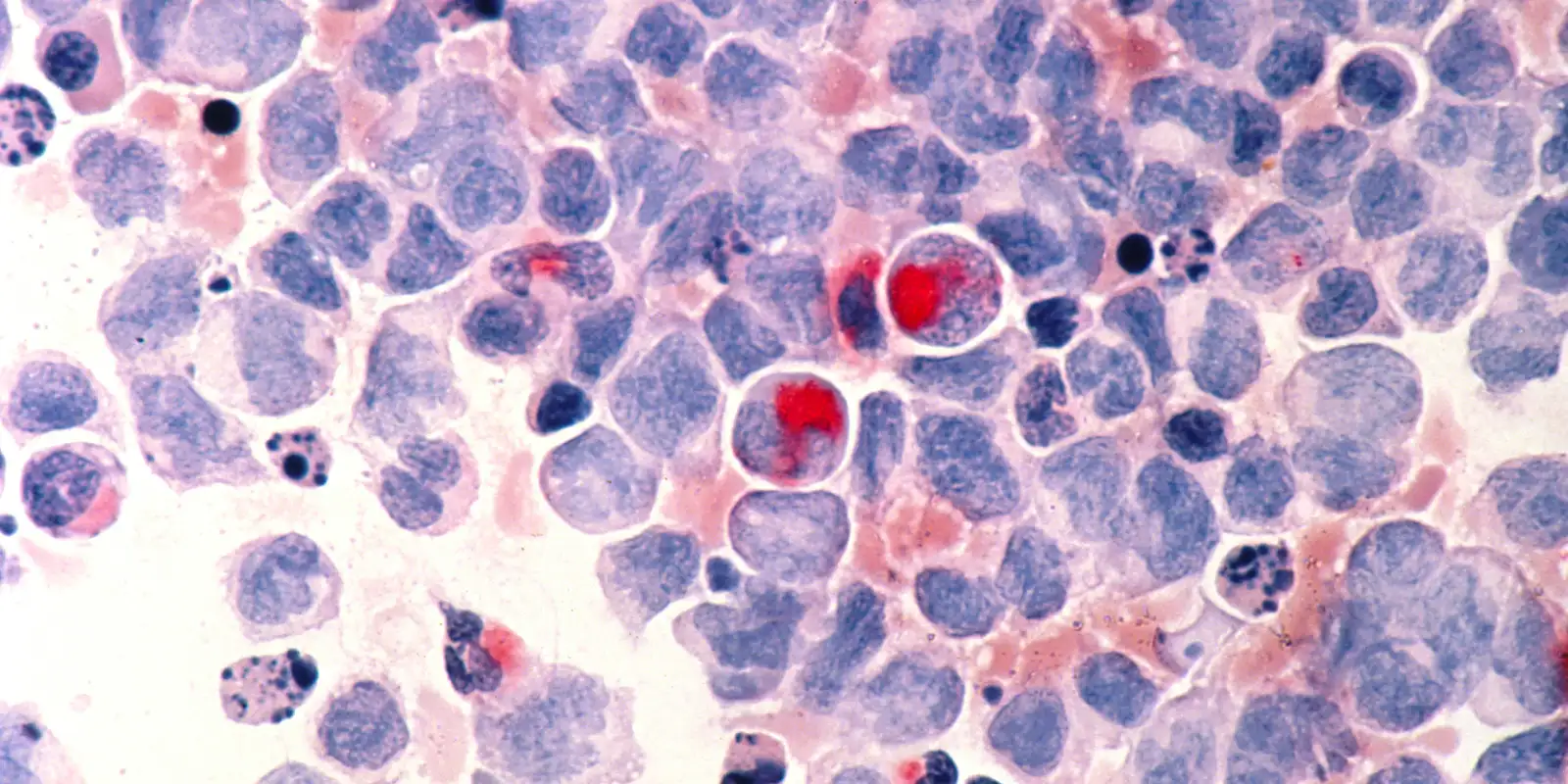 Fevereiro Laranja conscientiza sobre importância da doação de medula