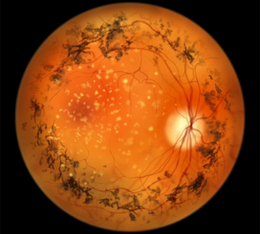 Terapia optogenética mostra sinais iniciais de recuperar funções visuais em pessoas cegas